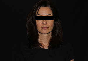 Filler in the Cheeks