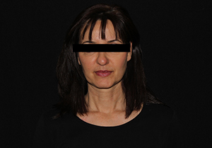 Filler in the Cheeks