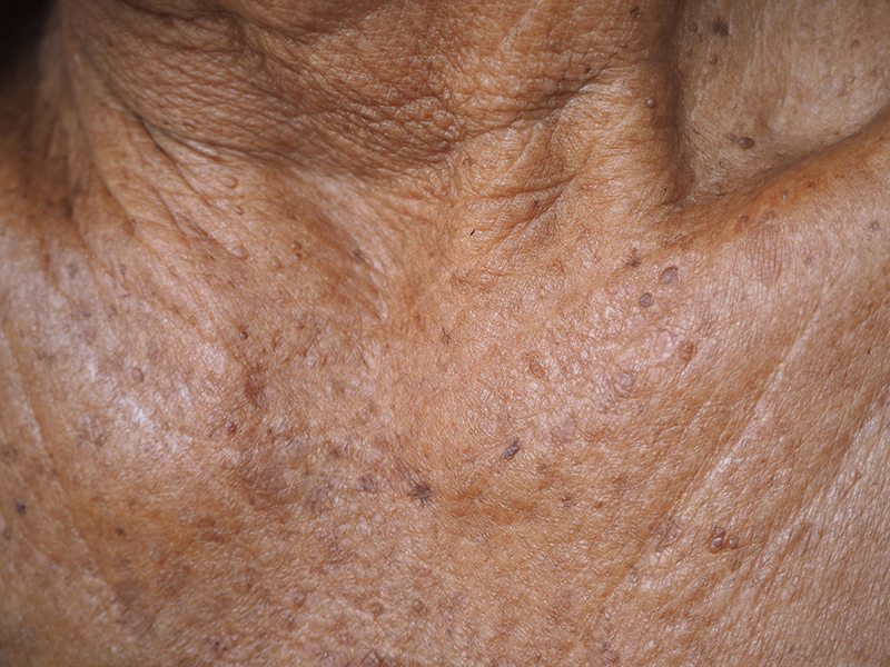 Actinic Keratosis
