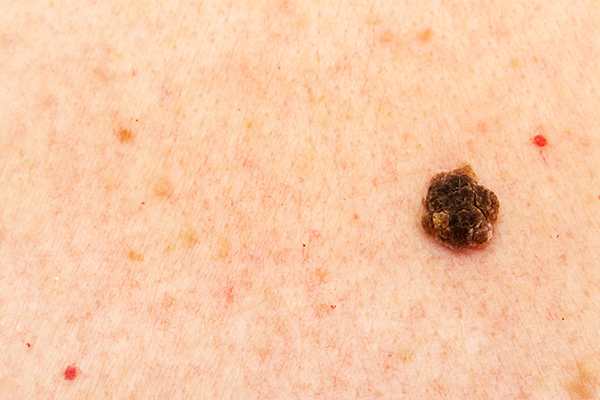 Seborrheic Keratosis