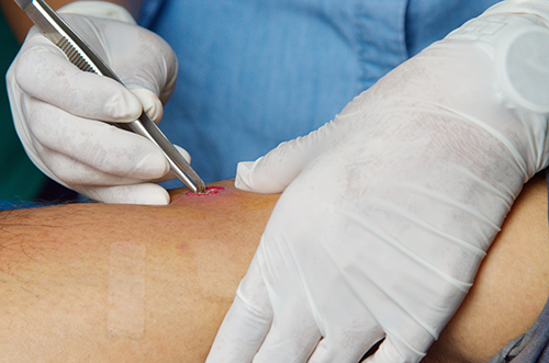 Incision and Drainage of Abscesses